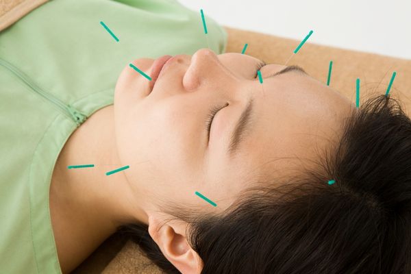 Acupuncture applied to facial paralysis ⁣